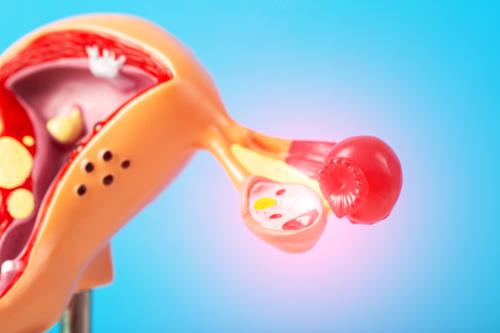 Fisiopatologia da Síndrome dos Ovários Policísticos: Bases Hormonais e Metabólicas