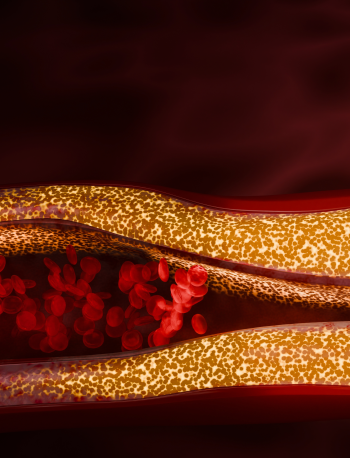 Diagnóstico diferencial de hipertrigliceridemia - lipodistrofias e SQF 