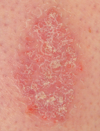 Manifestações dermatológicas no paciente com Diabetes 